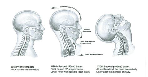 Whiplash Injury And Treatment Core Healthcare