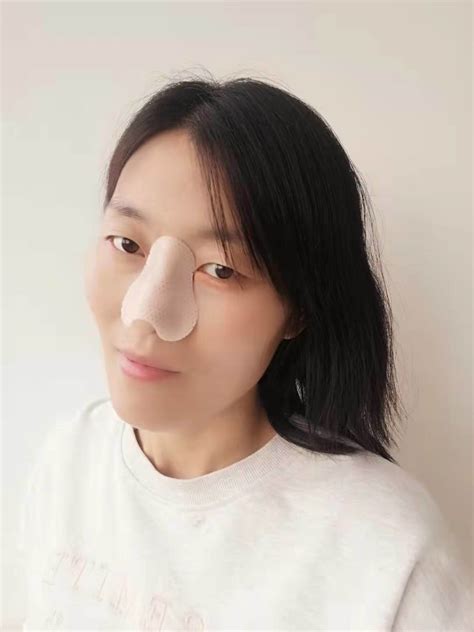 Thermoplastic Orthopedic Fracture Nose Cast External Nose Splint China Orthopedic Splint