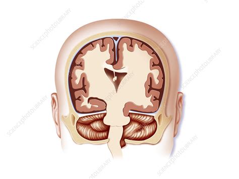 Subfalcine Herniation