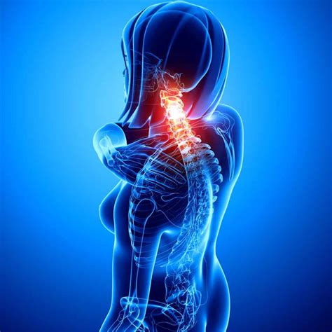 Cervical Spondylotic Myelopathy – Petersen Neurospine