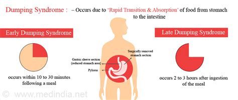 Dumping Syndrome: Causes, Symptoms & Treatments | Global Treatment Services Pvt. Ltd.