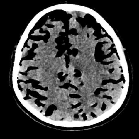 Sagittal Section Of Brain Ct Showing Significant Pneumocephalus With