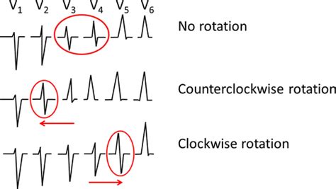 Counterclockwise And Clockwise Rotation Of QRS Transitional Zone