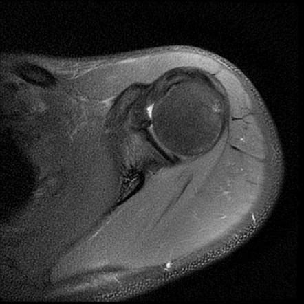 Acromioclavicular Joint Injury Type III MRI Image Radiopaedia Org