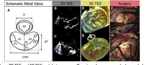 Figure From Quantification Of Mitral Valve Anatomy By 59 Off