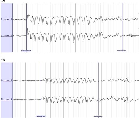 Absence Seizure