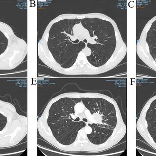 A, B, and C are the chest CT scan results from the first admission. D ...