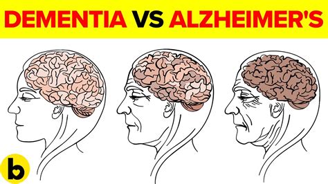 Dementia Vs Alzheimers How To Tell The Difference Youtube