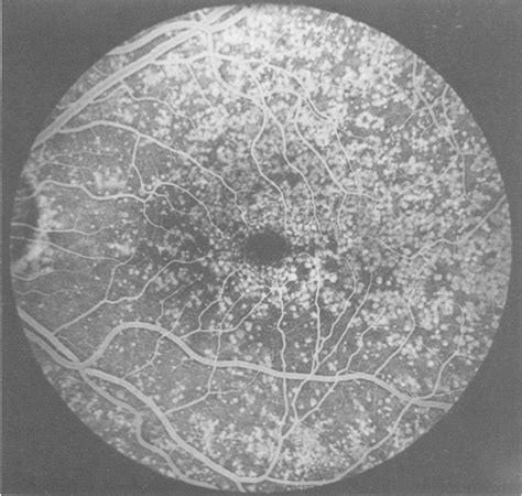 Fluorescein Angiogram Of The Left Posterior Pole Showing Extensive