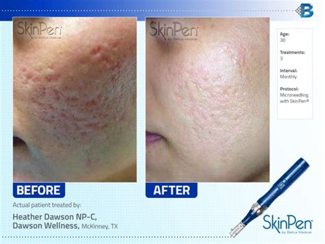 Dermarolling Before And After Acne Scars