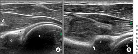 Figure 1 From Ultrasonography And Ultrasound Guided Interventions Of The Shoulder Semantic Scholar