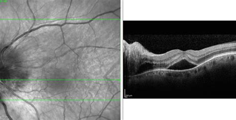 Non Arteritic Ischemic Optic Neuropathy With Serous Macular Detachment