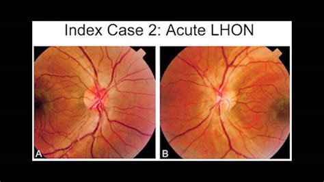 Leber S Hereditary Optic Neuropathy Youtube