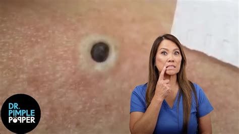 85 Year Old Blackhead Dr Pimple Popper Most Popular Pop Of All Time