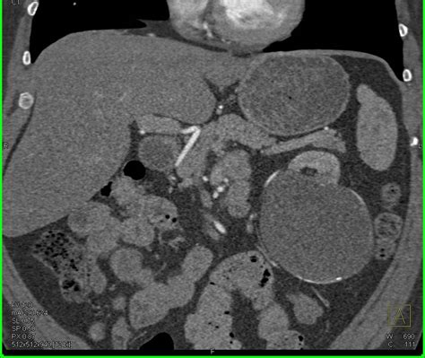 Bosniak 2F Cyst Needs Careful Follow-Up - Kidney Case Studies - CTisus ...