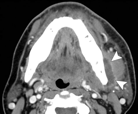 Ct Of The Neck Image Analysis And Reporting In The Emergency Setting