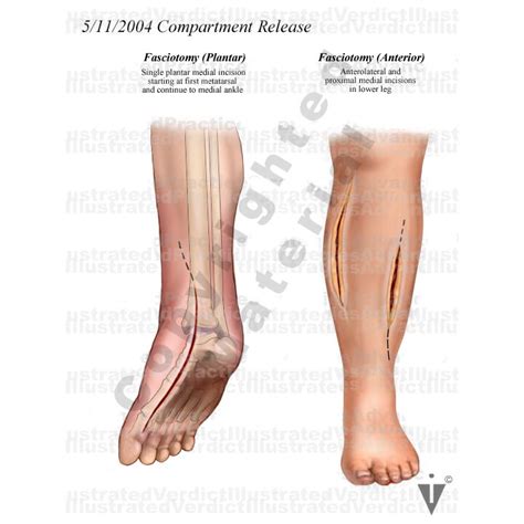 Stock Lower Limb: Compartment Syndrome — Illustrated Verdict