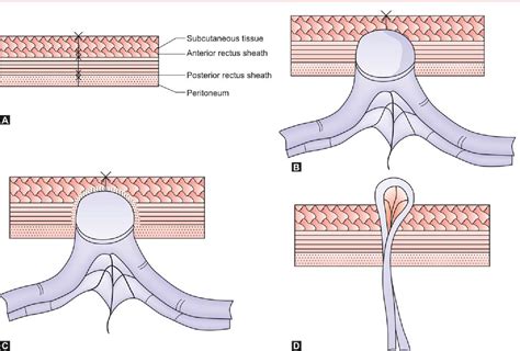 Figure From Trocar Site Hernia Semantic Scholar