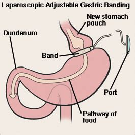 Bariatric Surgery Laparoscopic Adjustable Banding