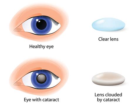 Cataract Surgery In Kochi | Cataract Surgery Cost in Kochi