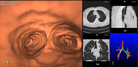 Frontiers Advancements In Navigational Bronchoscopy For Peripheral Pulmonary Lesions A Review