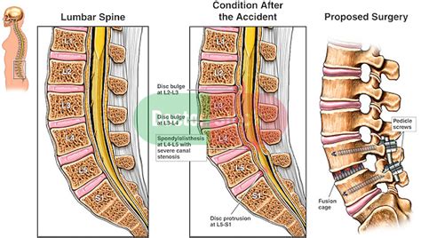 Lumbar Spine Injury L2 3 L3 4 Disc Bulges And L4 5 Spondylolisthesis