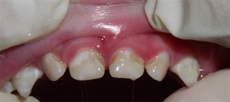 Black Lines On Molars