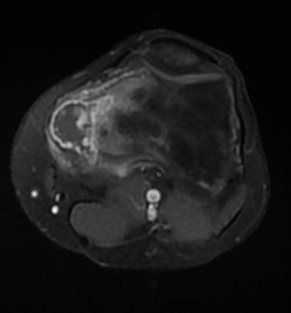 Chondrosarcoma Radiology Reference Article Radiopaedia Org