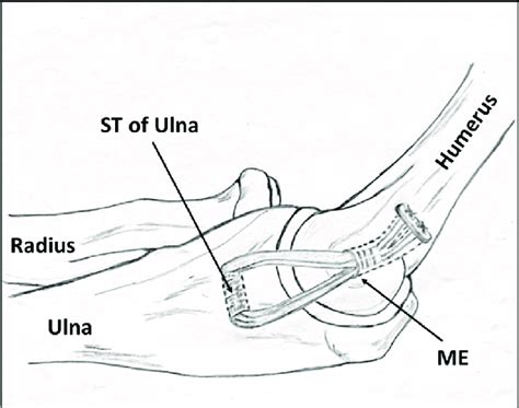 Illustration Of The Ulnar Collateral Ligament Reconstruction Technique Download Scientific