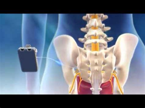 Overview Of Sacral Nerve Stimulation For Urinary Control Youtube