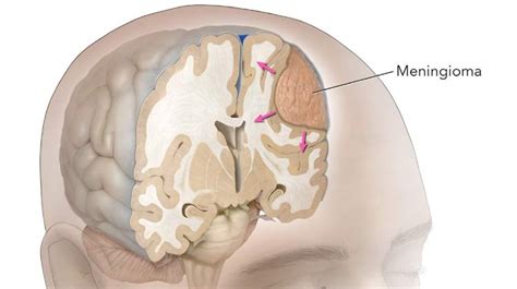 Meningioma Treatment in India: Causes, Procedure, Hospitals