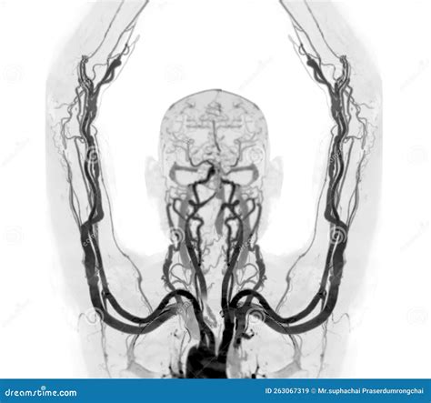 Cta Brachial Artery Or Ct Scan Of Upper Extremity Or The Arm 3d