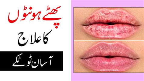 Phaty Hont Ka Ilaj Dry Lips Treatment Chapped Lips Treatment Home