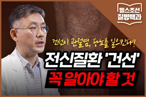 [질병백과 Tv] 건선이 관절염 당뇨를 일으킨다 전신질환 건선 꼭 알아야 할 것은