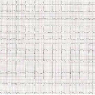 Electrocardiogram Showing Sinus Rhythm Relative Tachycardia At Bpm