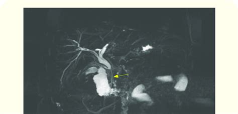 Mrcp Showing A Stent In The Common Bile Duct Yellow Arrow With A Long