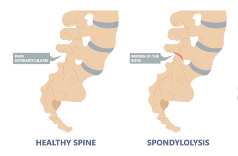 Spondylolysis: Definition - Spine Info