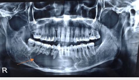 Panoramic Radiograph Showing A Single Large Unilocular Well Defined