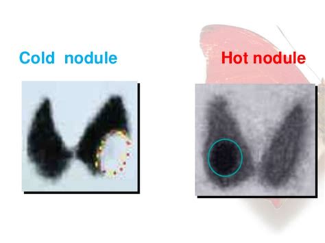 Thyroid nodules