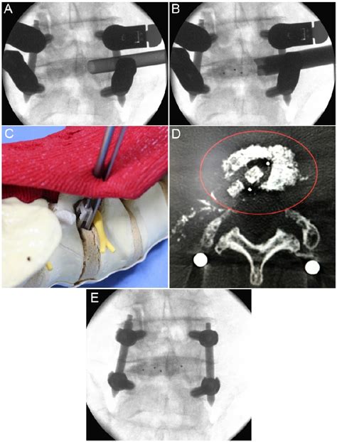 Figure 4 From Early Clinical Results Of Percutaneous Endoscopic Transforaminal Lumbar Interbody