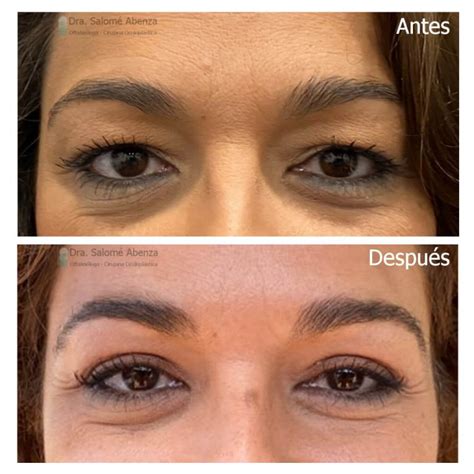 Antes y después Blefaroplastia superior Salomé Abenza