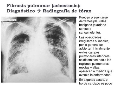 Asbestosis Pulmonar Pdf