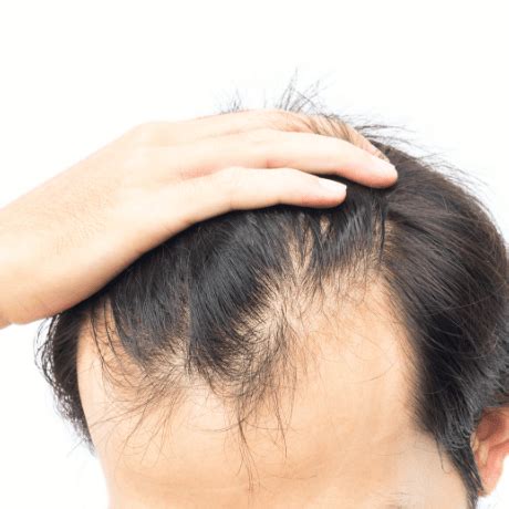 Do Hair Loss Shampoos Actually Work Skalp