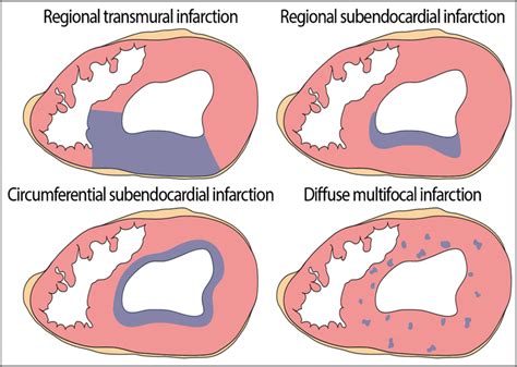 Patterns Of Topographic Distribution Of Mi In The Heart Regional Download Scientific Diagram