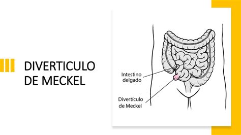 Divertículo de Meckel MISHELL ALEJANDRA SOLORIO PEREZ uDocz