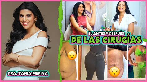 Antes Y Despu S De Las Cirug As De La Doctora Tania Medina Youtube