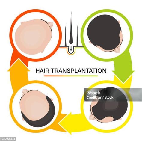 Hair Transplantation 4 Steps Infographics Stock Illustration Download