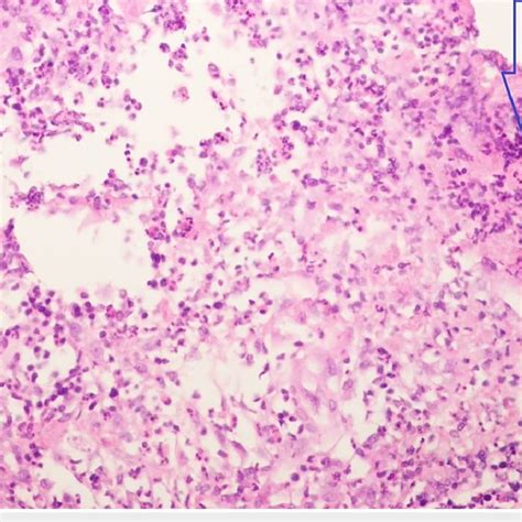 Histopathological Findings Of Acute Mastitis Demonstrating Areas Of