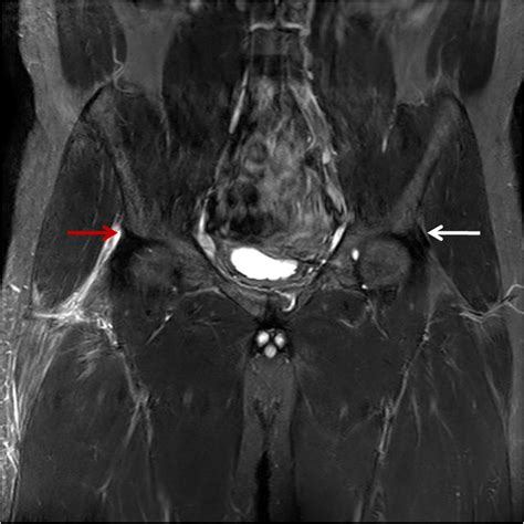 Proximal Rectus Femoris Tendon Tear Image Radiopaedia Org