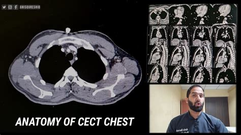 Anatomy of CECT CHEST | By Anis Qureshi - YouTube